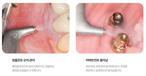 소아치과와 치아교정 전문 불당본점 서울비디치과의원의 전문 치료 안내